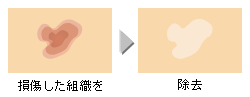 損傷した組織を除去