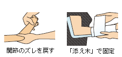 関節のズレを戻す 「添え木」で固定