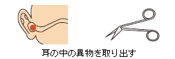 耳の中の異物を取り出す