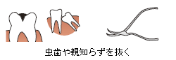 虫歯や親知らずを抜く