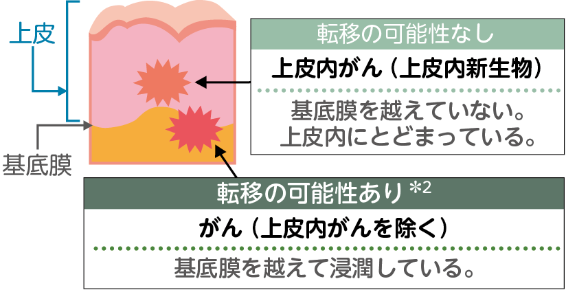 がんのステージとは?