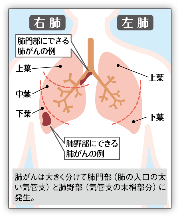 肺がん